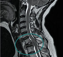 tumor columna, espinal, vertebral. Debe ser manejado por un neurocirujano especializado en columna