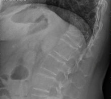 Fractura osteoporótica, el tratamiento debe ser indicado por un cirujano de columna