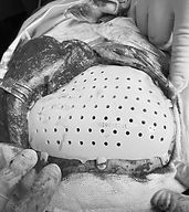 neurocirujano, craneoplastia